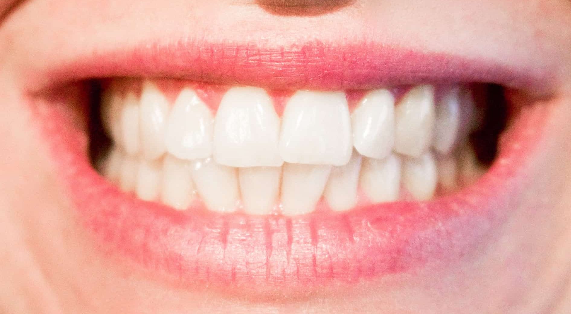 teeth 1652976_1920 Amalgam Sanierung